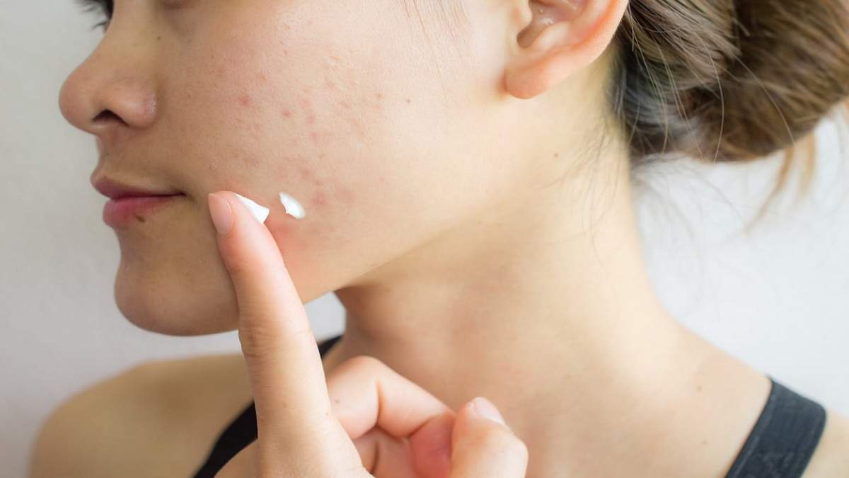 acne care gel acne treatment