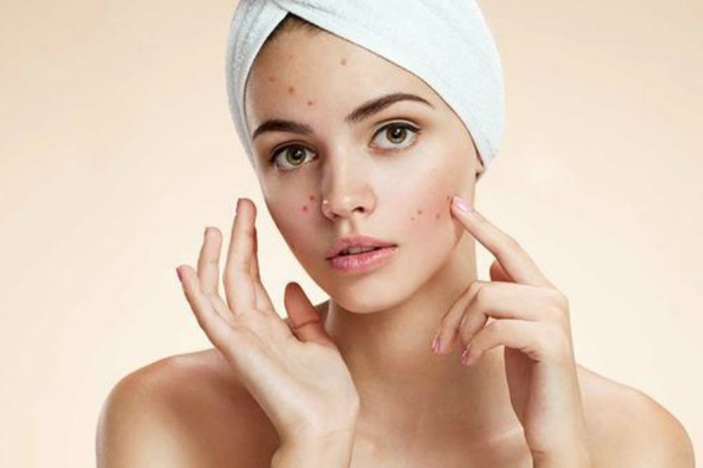 acne day cream premium